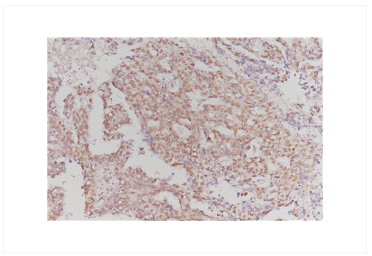 cancer biomarkers guide