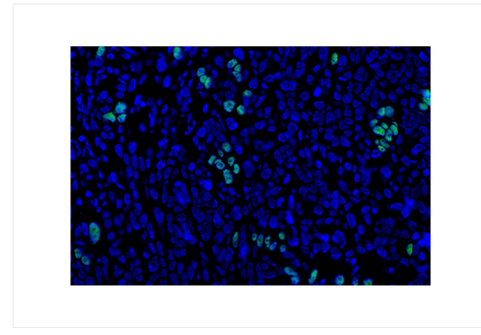 cancer biomarkers guide